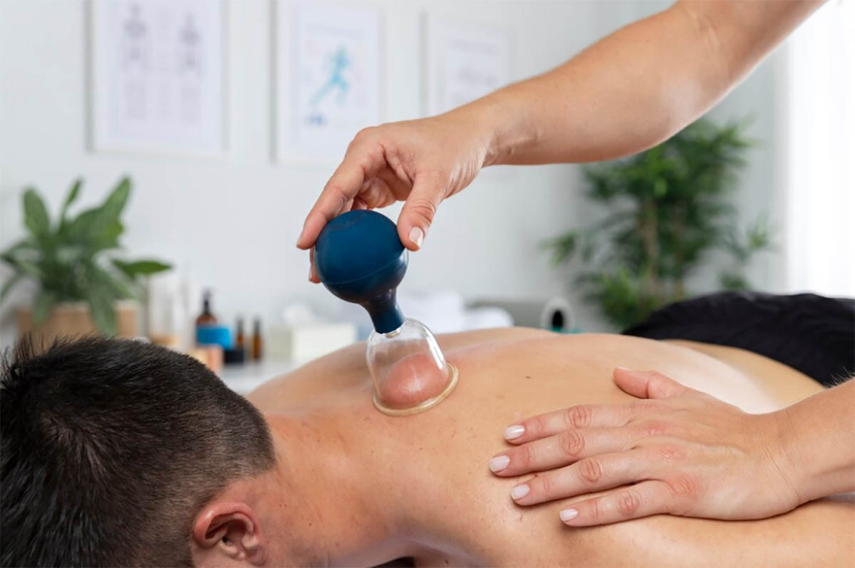 Types of Cupping Techniques for Back Pain