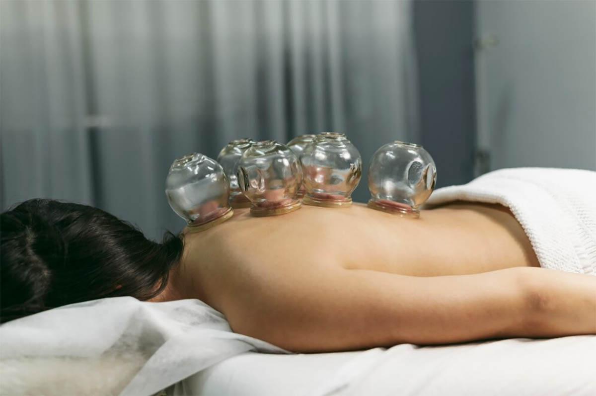 Cupping for Back Pain An In-Depth Look at Its Effectiveness